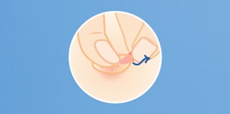 KROK 3 — zmiana koloru na biały oznacza, że czas zdjąć plaster na wypryski i nałożyć nowy
